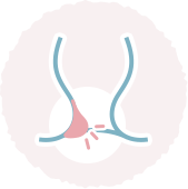 痔核