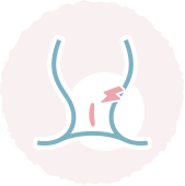裂肛