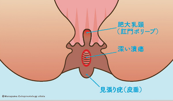 慢性裂肛