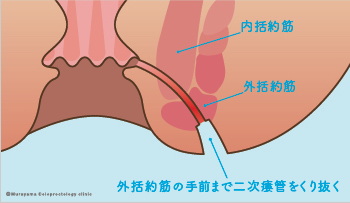 ①手術方法