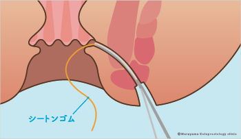 ②手術方法