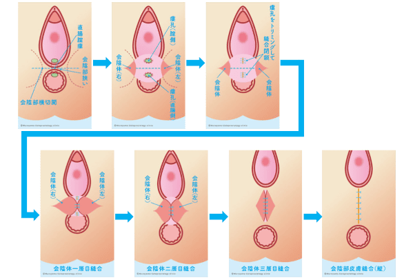 会陰体形成手術の説明