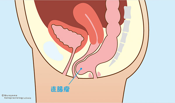 直腸瘤（ちょくちょうりゅう）とは？01
