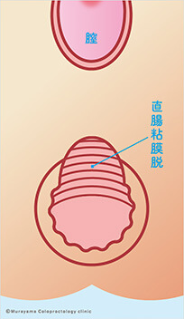 直腸粘膜脱
