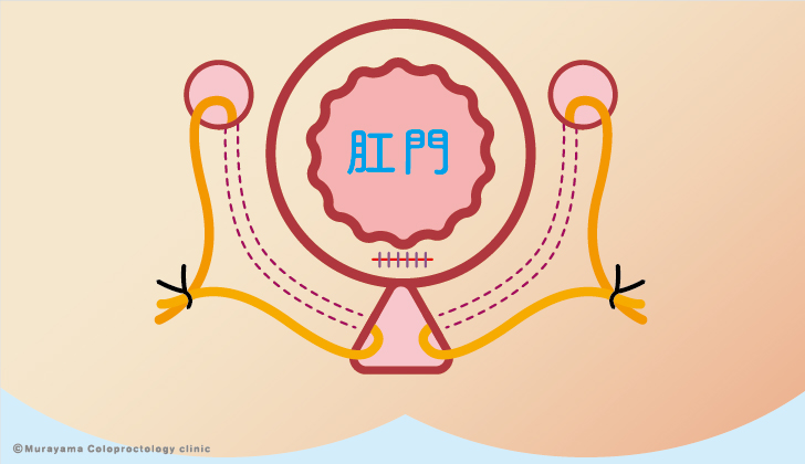 括約筋温存