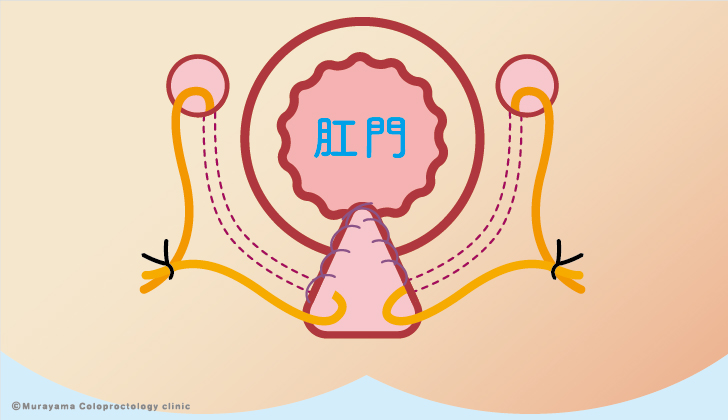 坐骨直腸窩痔瘻（ハンレイ）
