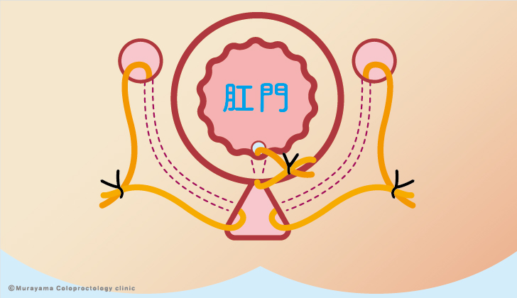 坐骨直腸窩痔瘻（シートン）