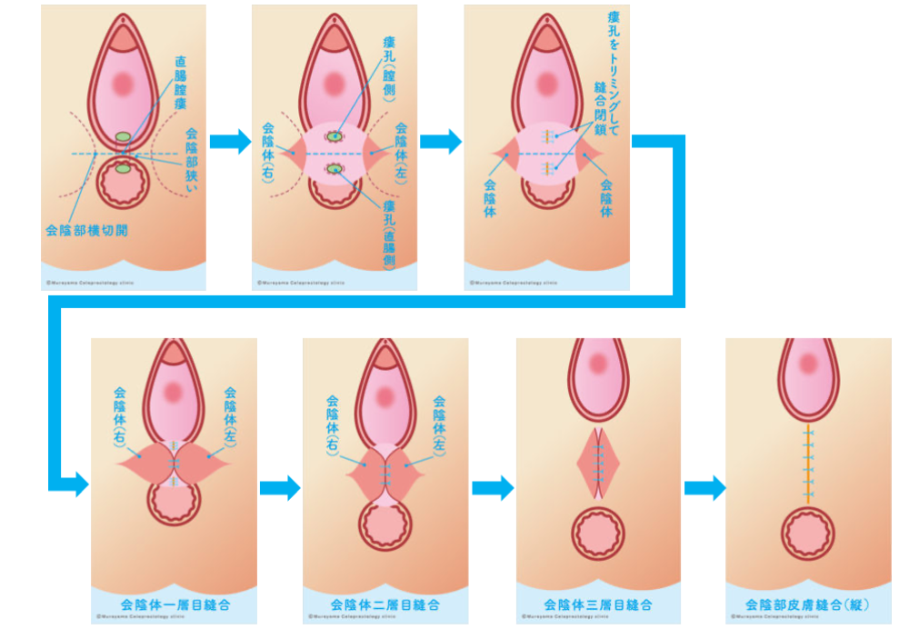 会陰体縫合