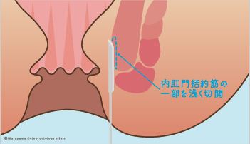 側方内括約筋切開術