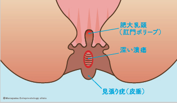 おしり 肛門 疾患説明 大阪市住吉区あびこ駅前の肛門外科 むらやま大腸肛門クリニック